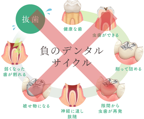 負のデンタルサイクル＝健康な歯、虫歯ができる、削って詰める、隙間から虫歯が再発、神経に達し抜随、被せ物になる、弱くなった歯が割れる、抜歯